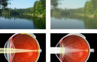 Šedý zákal (katarakta): Příčiny, průběh a moderní diagnostika