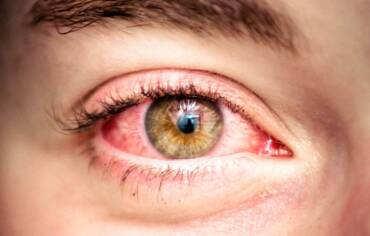 Syndrom suchého oka